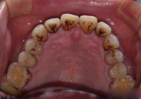 牙结石的危害图片大全图片
