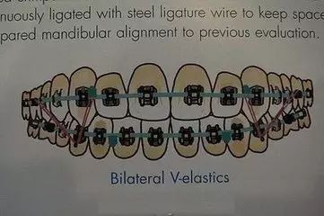 正畸橡皮圈用好了 牙齒矯正效果更好
