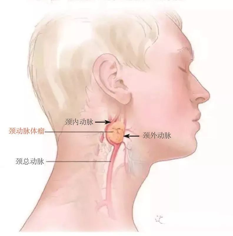 颈动脉体表位置图片