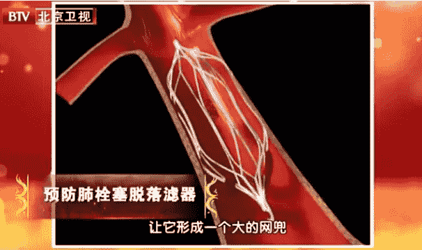 肺栓塞滤器图片