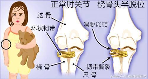 桡骨小头半脱位 复位图片