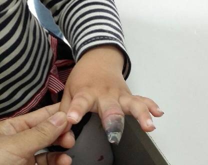 4龄童手指坏死截肢只因错用创可贴