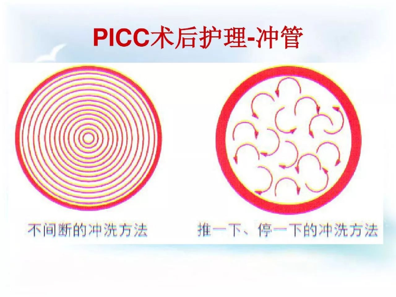 picc导管健康宣教