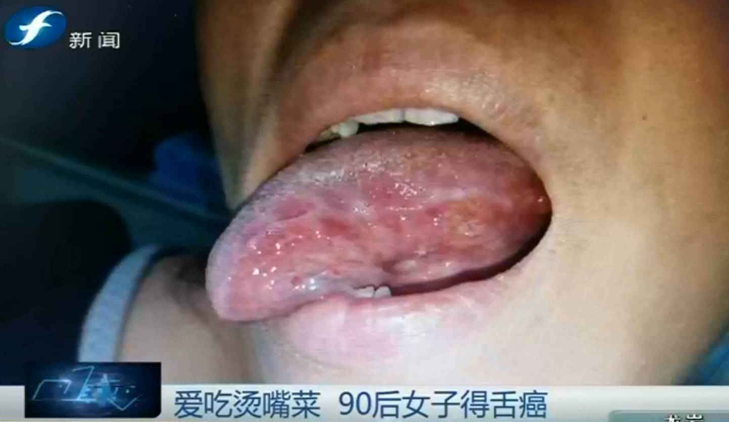 舌癌看什么科图片