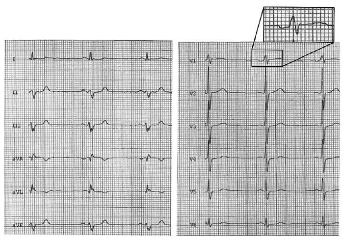 心电图可见v1及v2导联宽大的r波