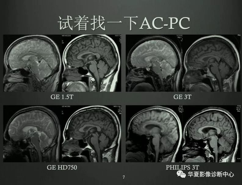 来说说你用的头颅mri扫描定位线