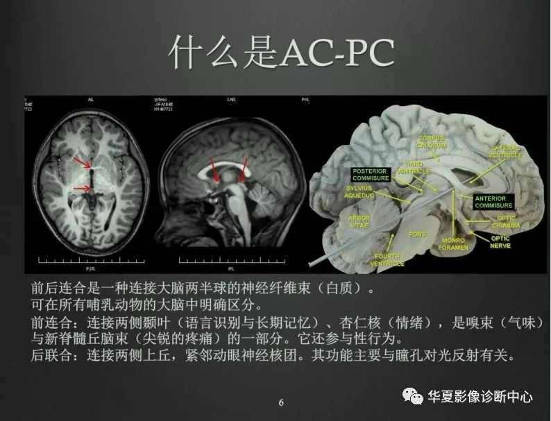 ac—pc线解剖图图片