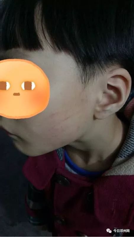 邓州某小学老师打人,孩子被扇耳光,面部有手指印和淤血