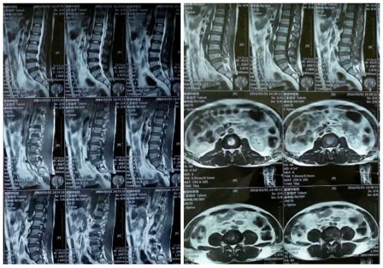 腰间盘突出l5/s1图片