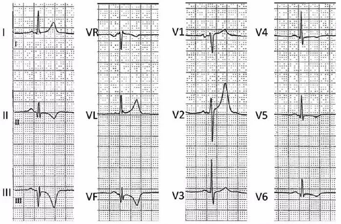 后壁心梗心电图特点图片