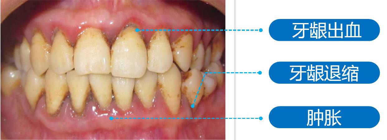 肿胀,牙龈退缩,其实这些也就是我们常说的牙周病的一系列症状