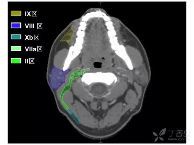 ix 面颊淋巴组viii 腮腺淋巴组viia 咽后淋巴结;viib 茎突后淋巴结vii