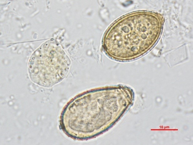 镜检发现典型华支睾吸虫(clonorchis sinensis,肝吸虫)虫卵,数