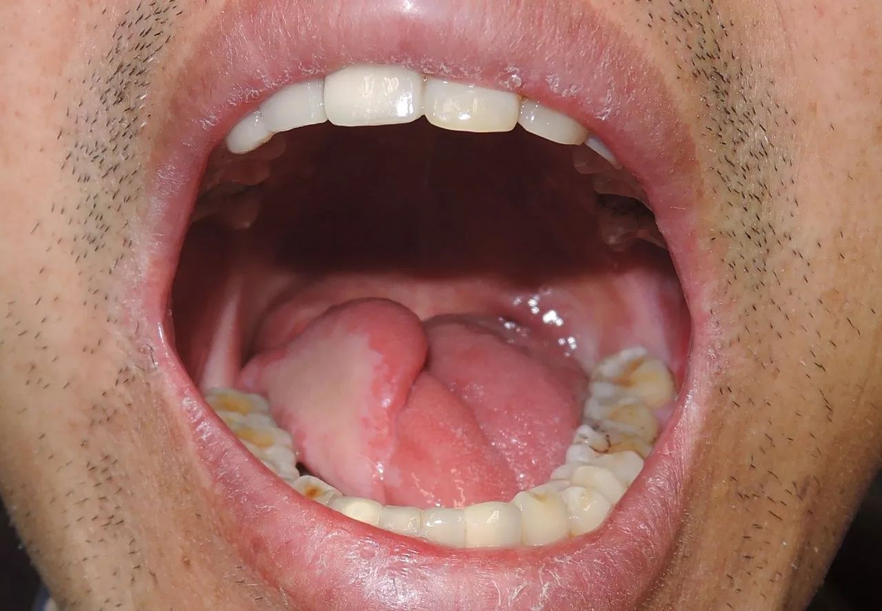 舌头根部长溃疡图片图片