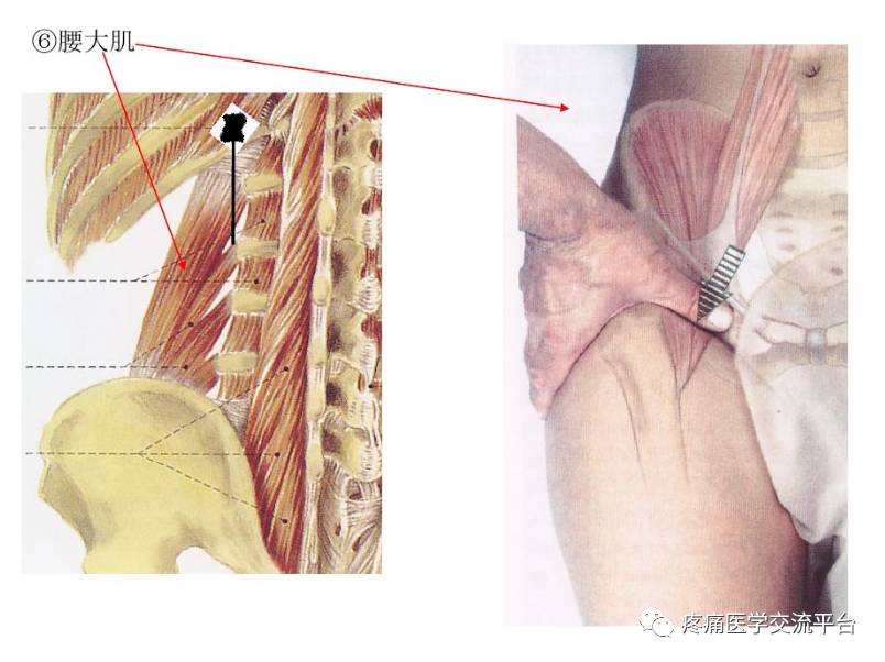 (针刀篇)腰骶部针刀治疗