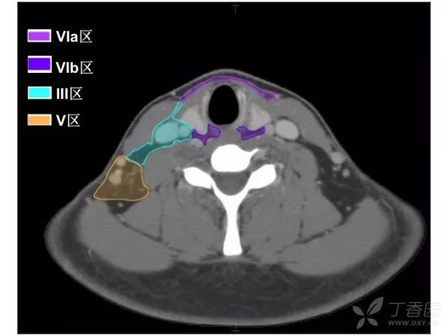 史上最精细头颈部淋巴结分区ct图谱