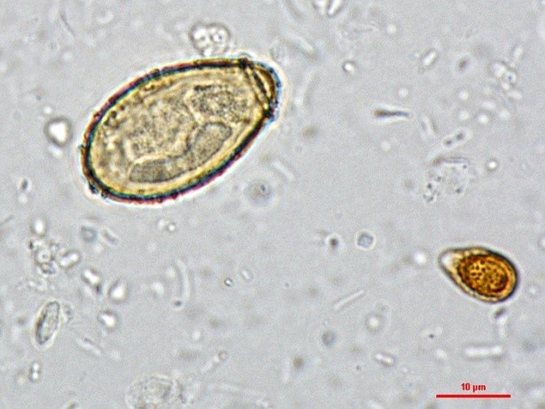 镜检发现典型华支睾吸虫(clonorchis sinensis,肝吸虫)虫卵,数量较多