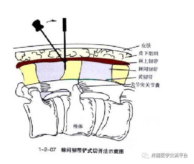 (针刀篇)腰骶部针刀治疗