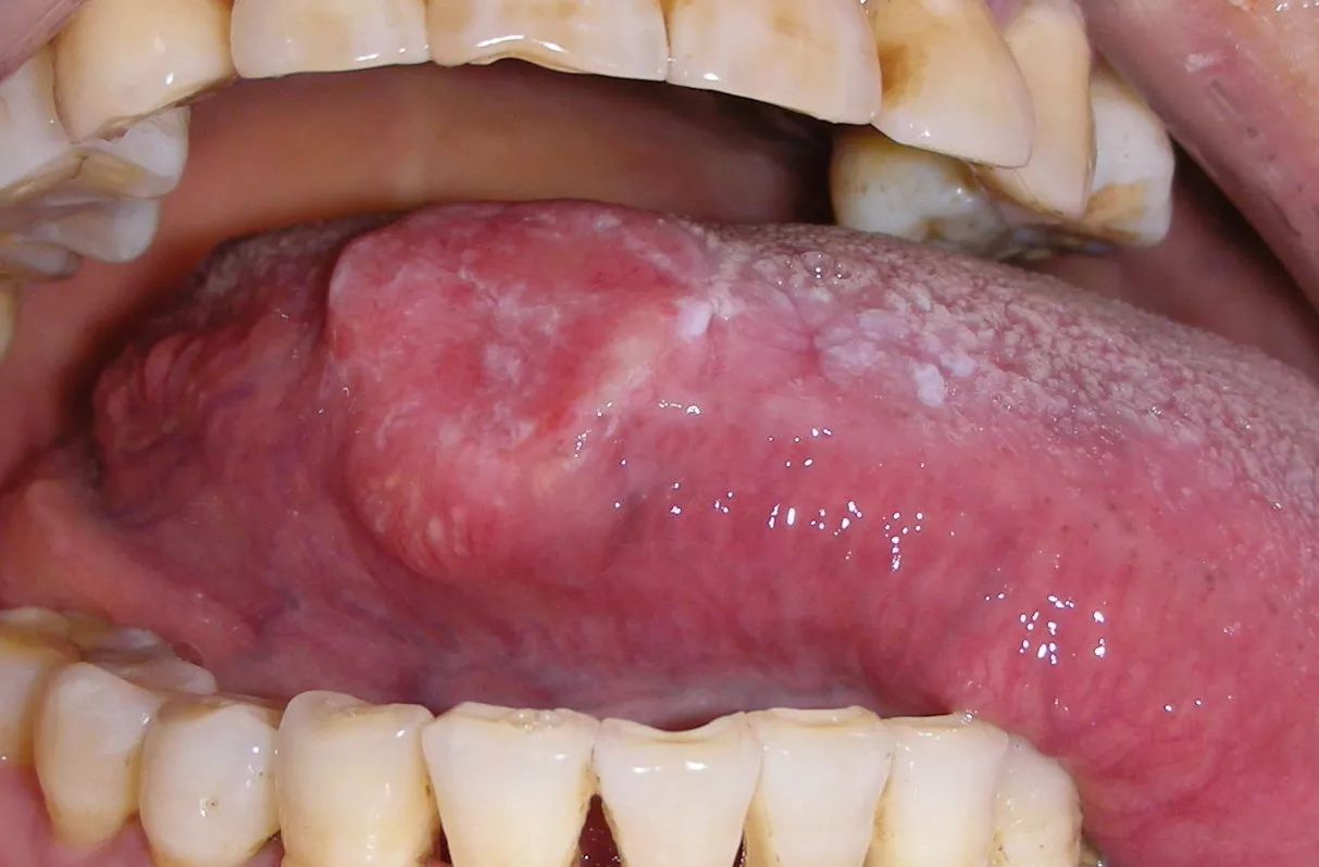 舌头上溃疡舌癌图片