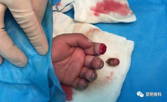 4岁男童手指被夹断,昆骨专家妙手仁心断指再植成功