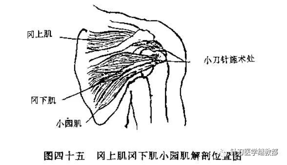 每日一例小針刀治療岡上肌損傷