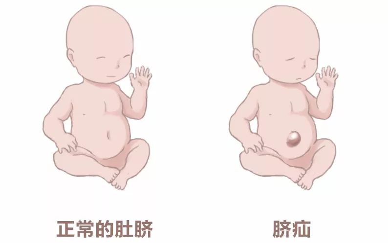 小儿疝气主要有两大类,腹股沟疝与脐疝