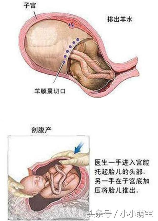 孕妇剖腹产全程,准妈就别看了,看完会心疼