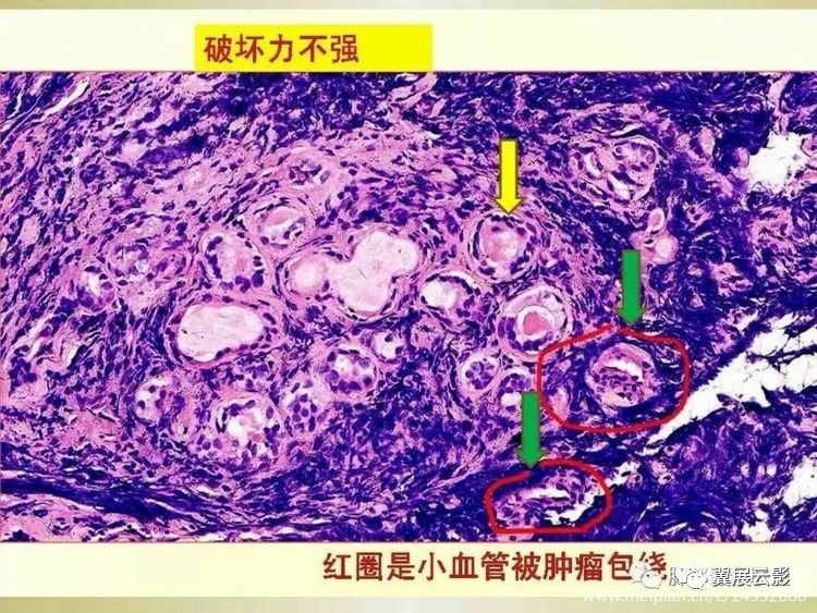 小细胞癌图片特点图片