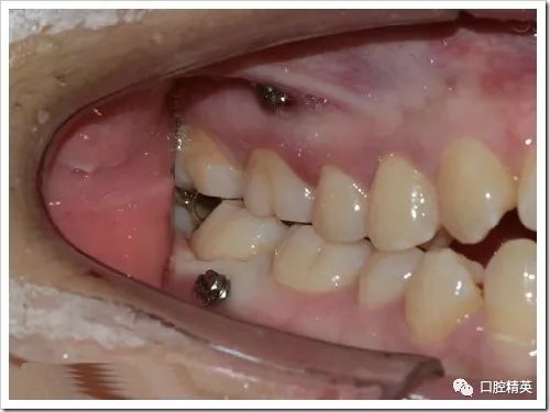 关于mia的值得强调的几个问题:1,上颌种植钉常见位置在5,6之间;下颌