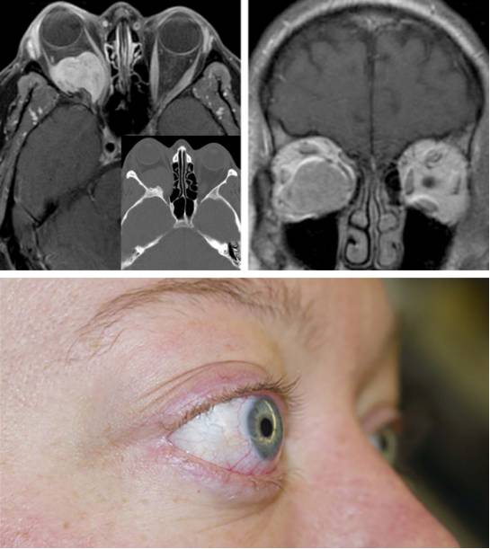 眼眶肿瘤的手术技巧与策略丨the neurosurgical atlas系列