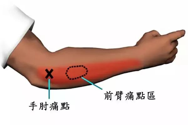 一般在肱骨外上髁处有局限性压痛点