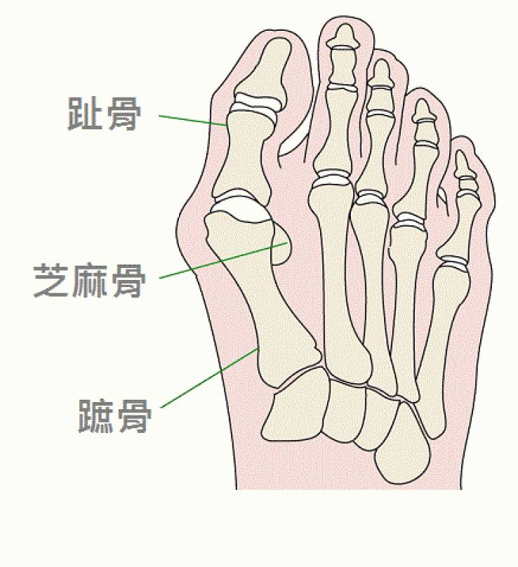 拇趾跟脚掌之间的关节称为第一跖趾关节