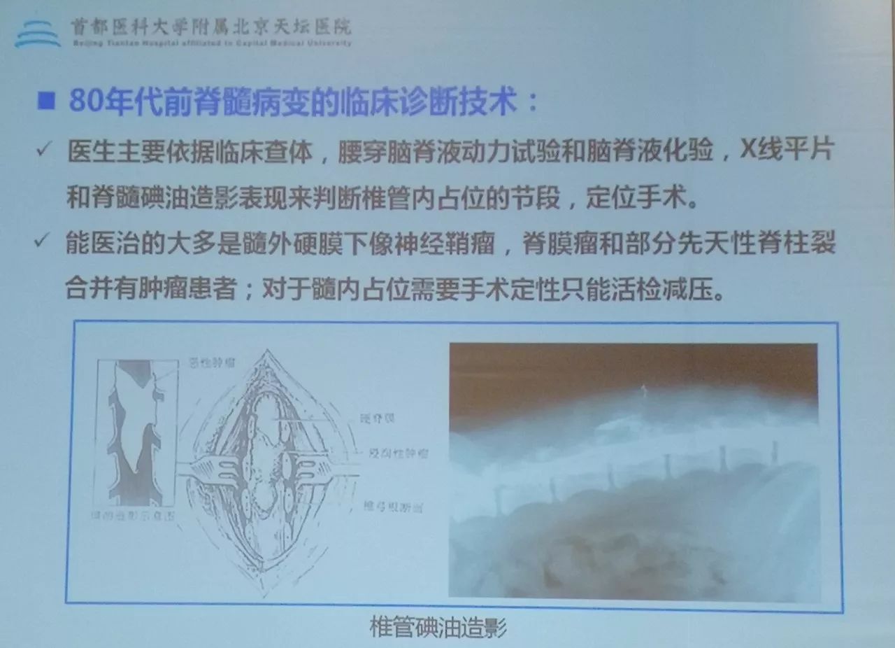 [会议现场]天坛医院杨俊: 天坛神外脊髓专业30余年历史与发展