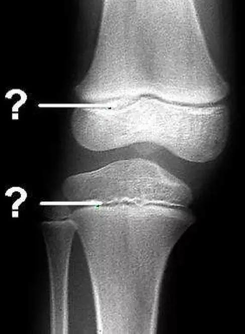 儿童膝关节骨骺图片图片