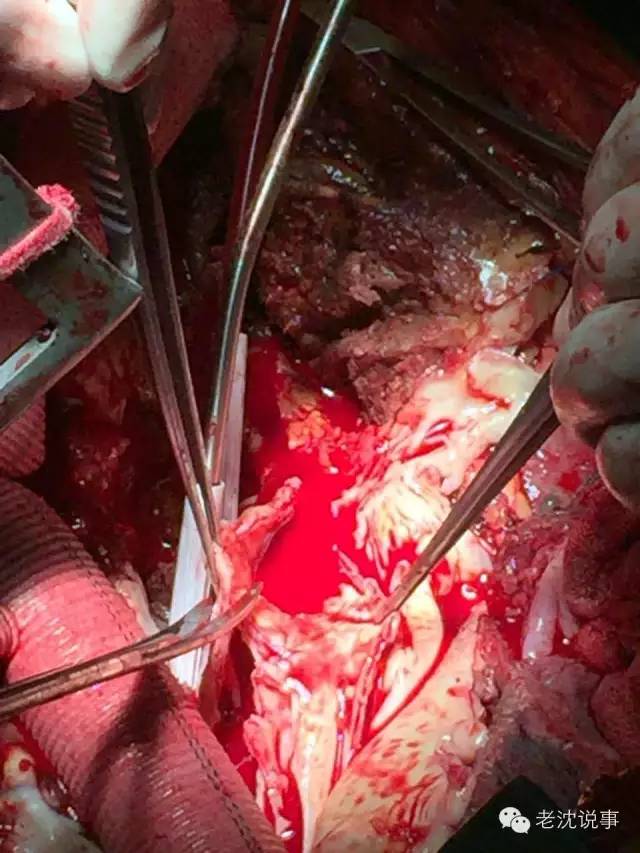 医生用手将血管内部的血液凝块取出,上图金属盆中即是已经机化的血块