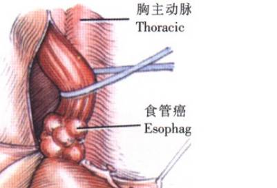 食管癌病人口水_食管癌晚期病人图片