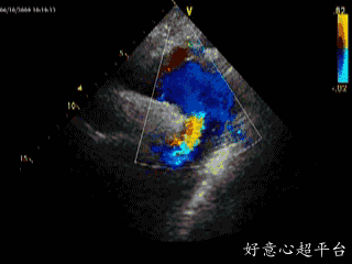 主动脉夹层iii型,cdfi显示真腔和假腔