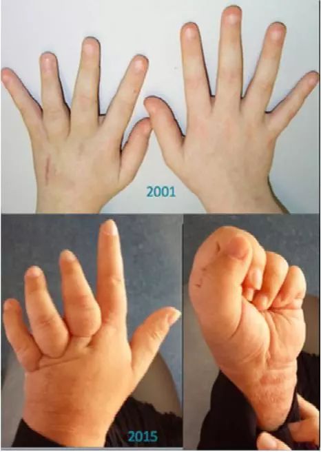 有奖病例竞猜 第111期丨手指变形,肿大——这个女孩的手怎么了?