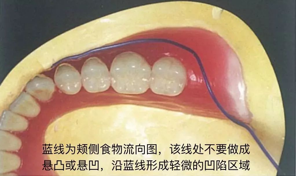 假牙结构图图片