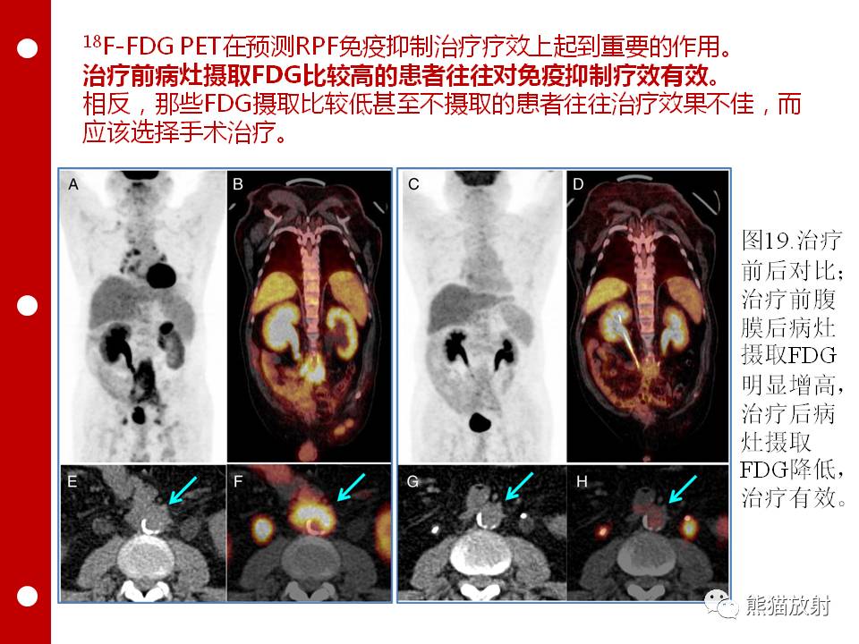 petct病案討論腹膜後纖維化影像學特點ctmri