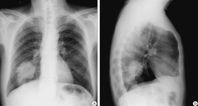 肺癌的片子图片图片