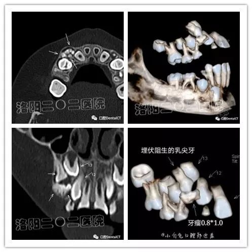 一例牙瘤合并乳尖牙埋伏阻生的微创拔除