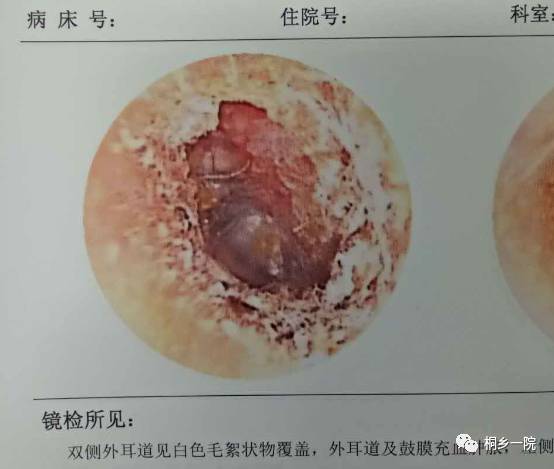 当耳朵里患上脚气病