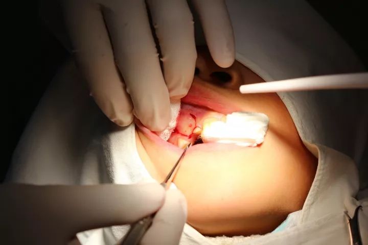 一例牙瘤合并乳尖牙埋伏阻生的微创拔除