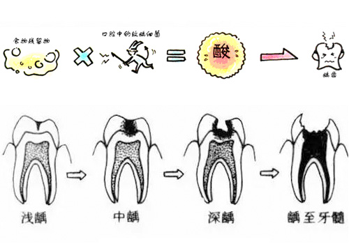 蛀牙原因简笔画图片