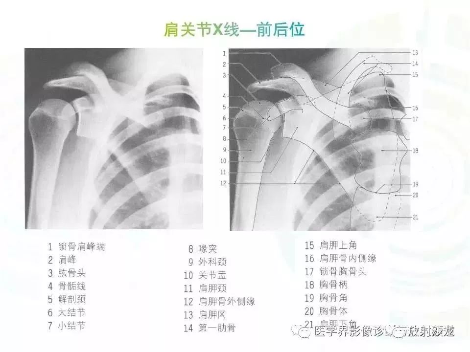 肩关节平片解剖图片