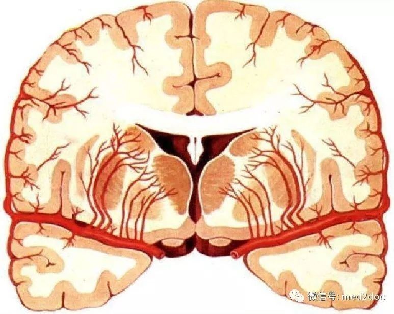 腦卒中是這樣發生的!