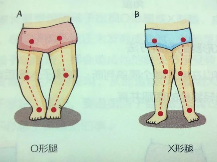 3歲後,又會呈現出膝關節向外翻,雙腿向內側彎曲的姿勢,稱為x型腿