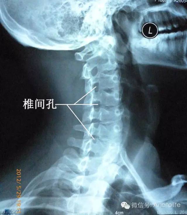 颈椎双斜位报告模板图片