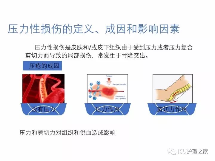 压力性损伤的预防与护理